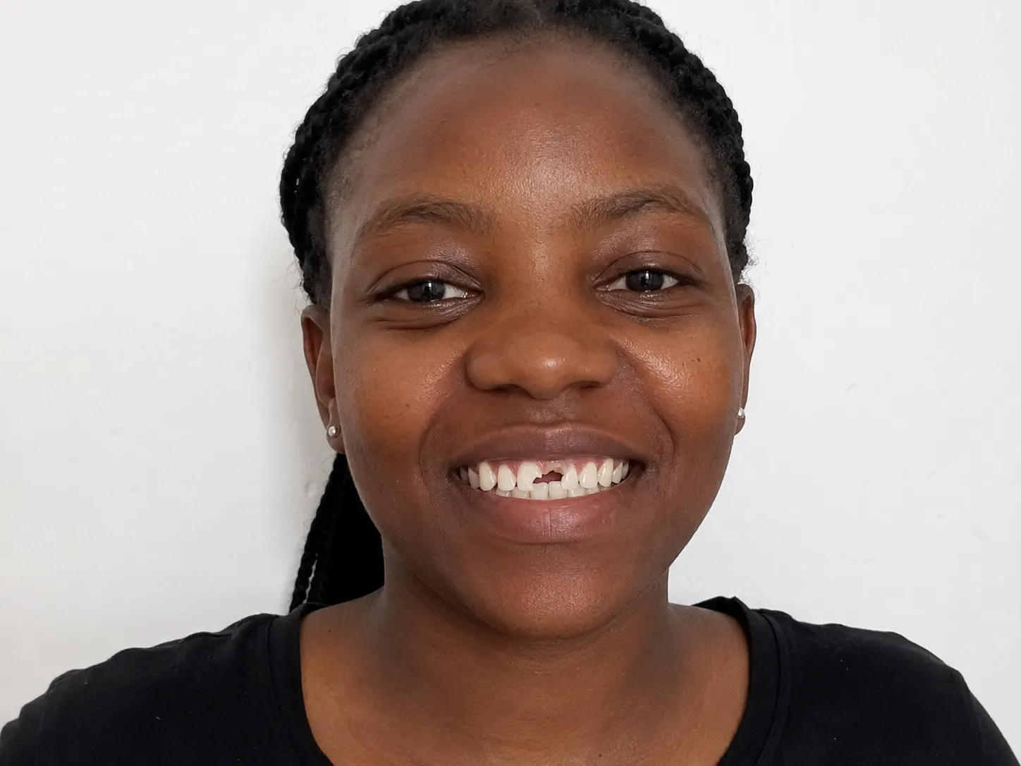 Dental Implants — before treatment at Urban Dental Clinic