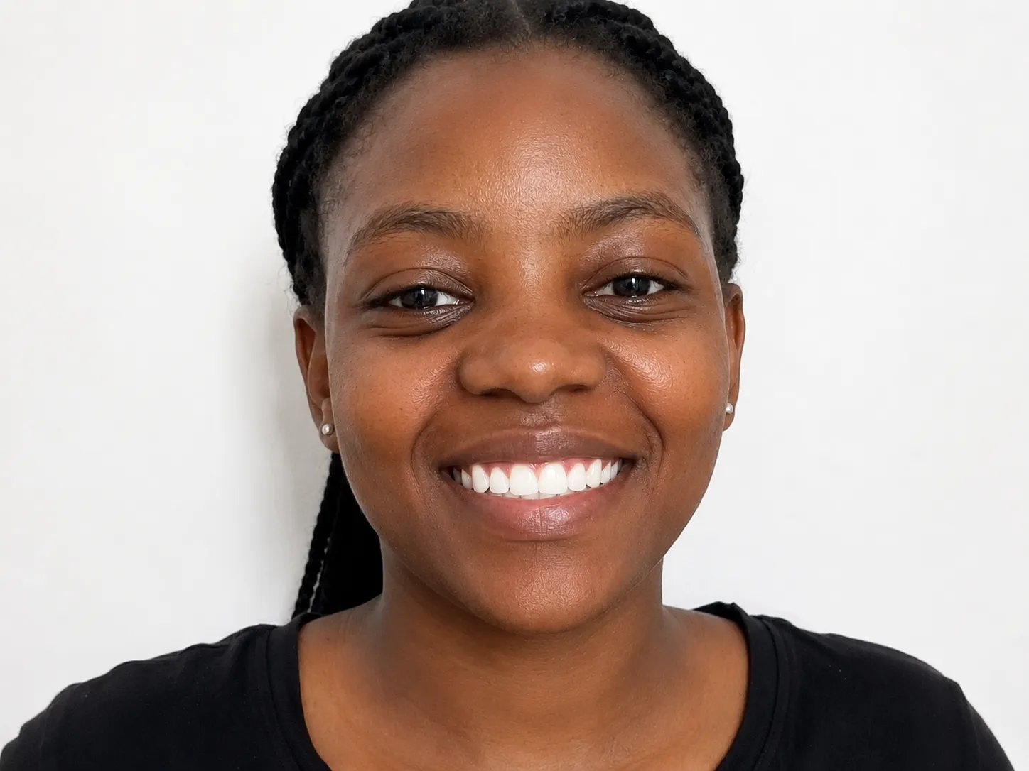Dental Implants — after treatment at Urban Dental Clinic